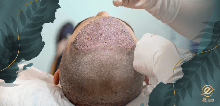 همه چیز در مورد کاشت مو به روش sut 