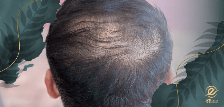 کاشت مو در ناحیه ورتکس