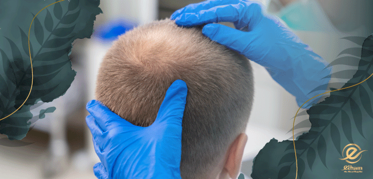 چه چیزهایی بعد از کاشت مو ضرر دارد